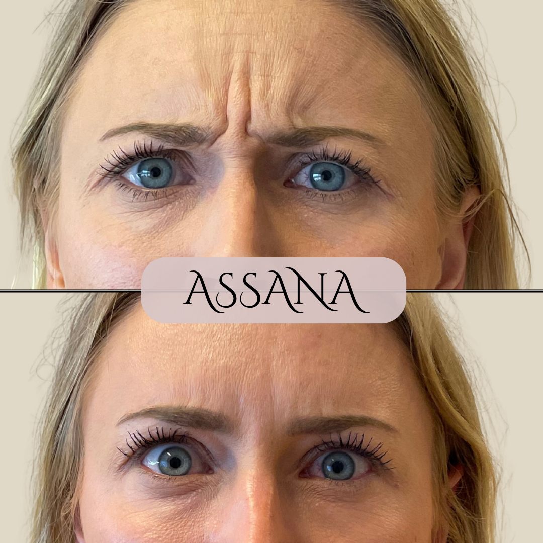 Før og efter behandling hos Klinik Assana