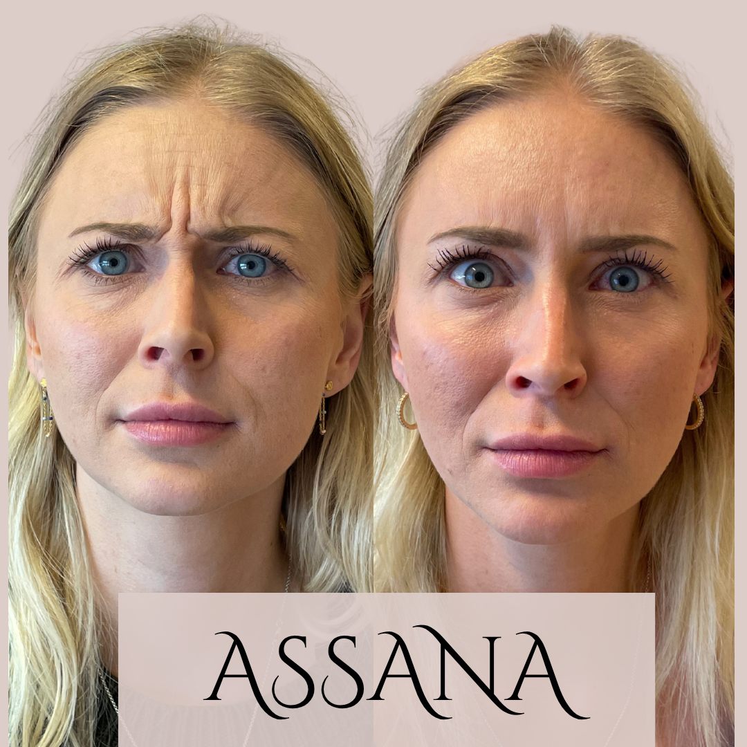 Før og efter behandling hos Klinik Assana