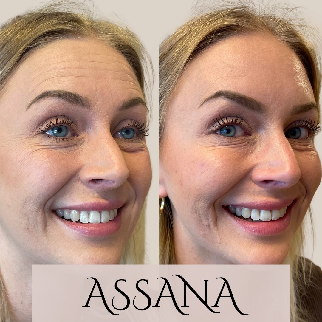 Før og efter behandling hos Klinik Assana