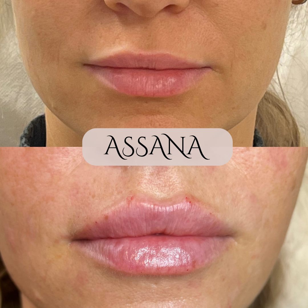Læbefiller – naturlig fylde og definition, før og efter hos Klinik Assana